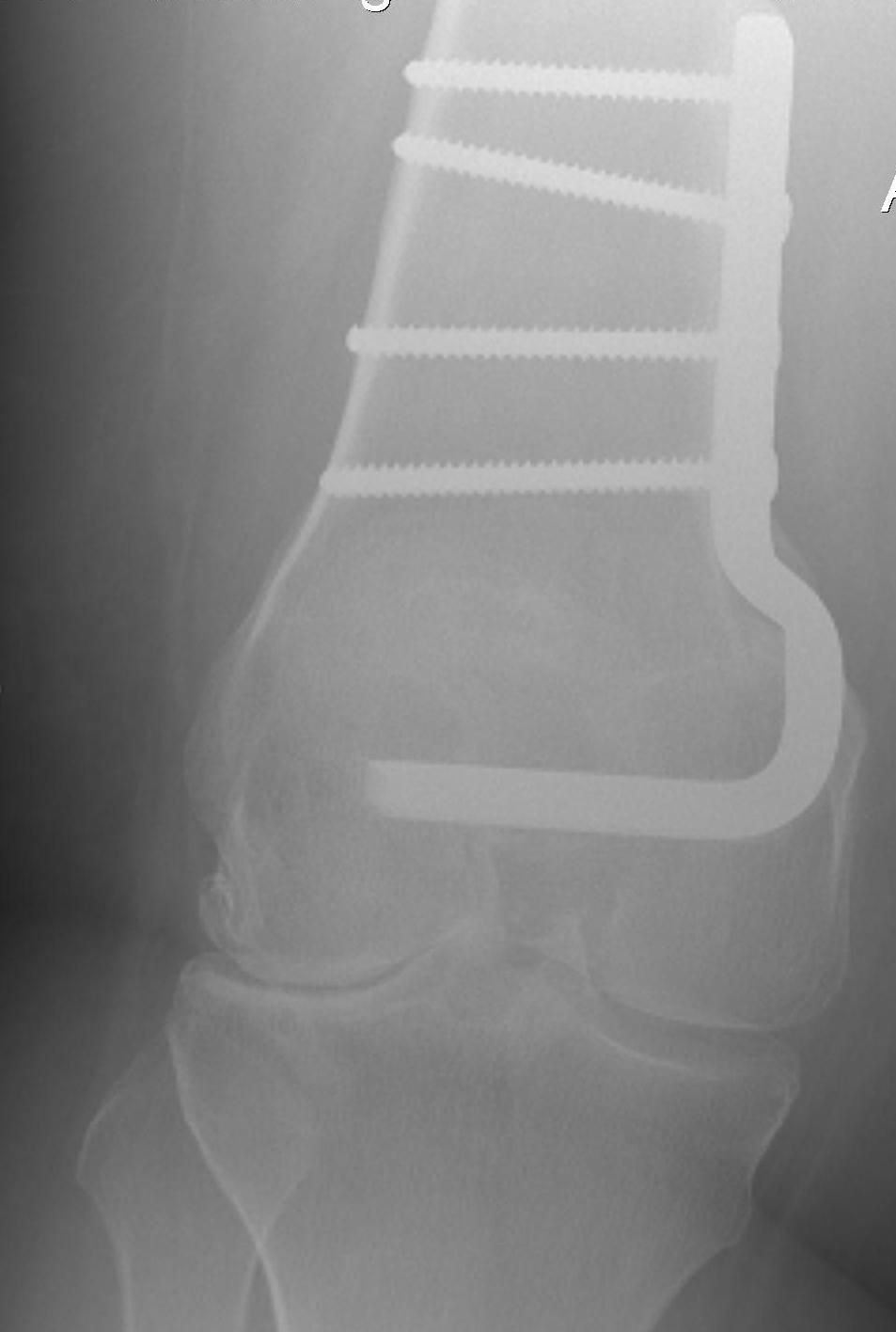 Distal Femoral Osteotomy Medial